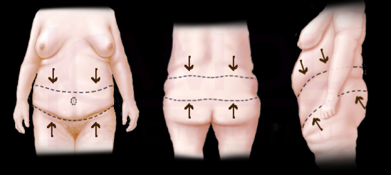 Abdominoplastia circunferencial