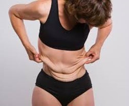 Abdominoplastia em âncora