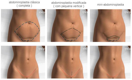 Abdominoplastia — desenho da cicatriz