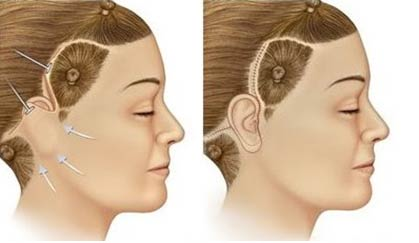Posição no lifting de face