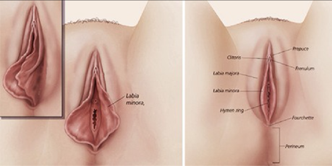 Cirurgia de ninfoplastia
