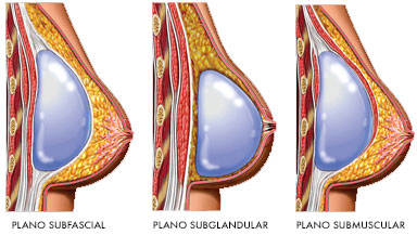 Posições do implante de silicone