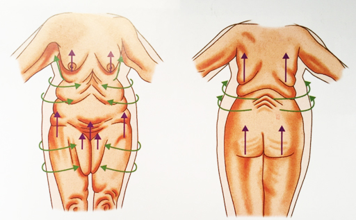 Toracoplastia — lifting de tórax
